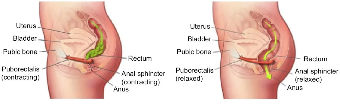 Diagram of a contracting pelvic floor blocking the exit of stool vs relaxed pelvic floor allowing stool to pass