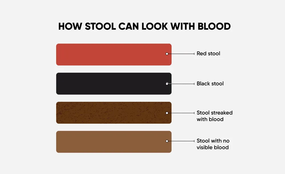 Anatomical diagram of the GI tract color-coded to show how bleed location affects stool color