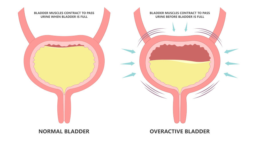 Anatomical illustration showing the detrusor muscle surrounding the bladder and the urethral sphincters