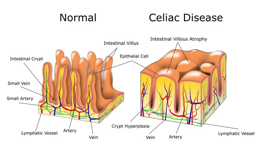 Medical illustration comparing healthy intestinal villi with the blunted villi characteristic of severe Celiac disease